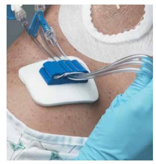 Medline Tubing Anchor - Case of 50 - ANC52XT-CS