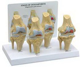Alimed 4 Stage Osteoarthritis Knee Model GPI Anatomicals - Each - 2970008279-EA