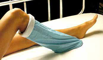 Alba Healthcare Surgical Stockinette Impervious / Tubular Albahealth® 12 X 48 Inch Sterile - Case of 10 - 85512-CS