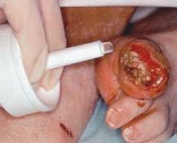 Smith & Nephew Hydrogel Wound Dressing Intrasite 15 Gram - Each - 66027311-EA