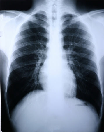 Medlink Imaging X-Ray Film Clear Choice™ Performance 14 X 17 Inch Duplicating - Case of 500 - 135448-CS
