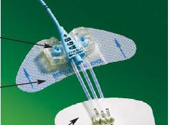 BD Catheter / Line Securement Device StatLock® CV Plus - Box of 25 - CV0226-BX