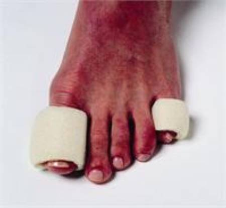 Pedifix Toe Bandage Pedifix Pull On Toe - Pack of 6 - 8137-3-PK