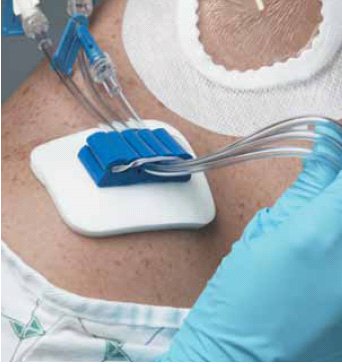 Medline Tubing Anchor - Case of 50 - ANC32XT-CS